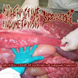 Putrefactive Endometriosis : Necrotic Crust of Ulcerative Vaginal Tumour
